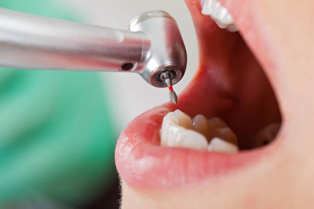 Best Emergency Dentist for Lost Fillings or Crowns in Lynwood, CA